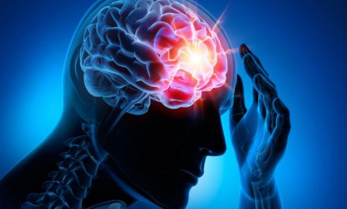 Fyra vanliga cerebrovaskulära sjukdomar