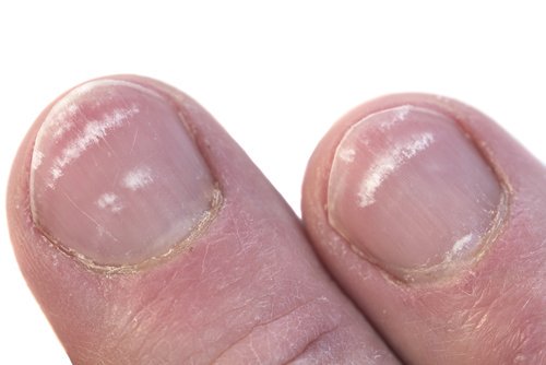 Vita fläckar på naglarna