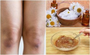 Få ljusare knän med 5 naturliga exfolianter