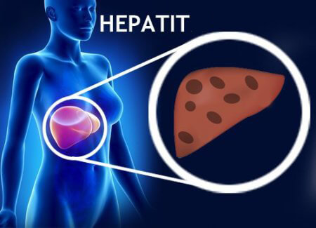 Hepatit i levern