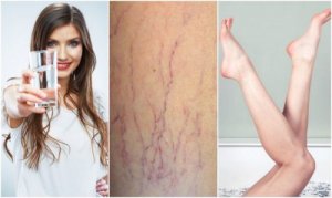 6 tips för att kunna motverka åderbråck