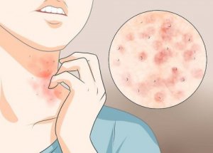 Tre enkla huskurer som motverkar skabb