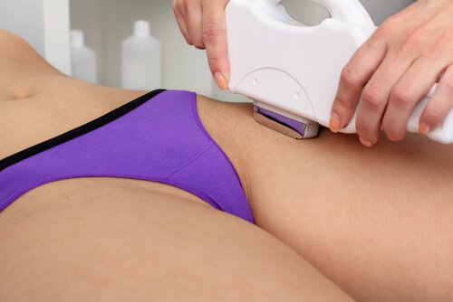 Hårborttagning med laser