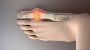 Åtta livsmedel som kan minska urinsyran i kroppen