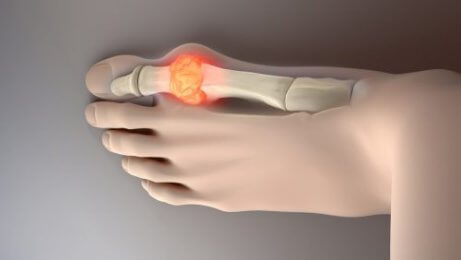 Åtta livsmedel som kan minska urinsyran i kroppen