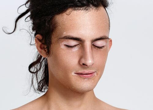 Person med vitiligo i ansiktet