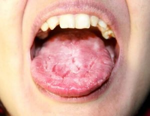 Candidosis – vad är det och hur undviker man det?
