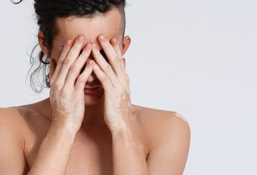Vitiligo på händer