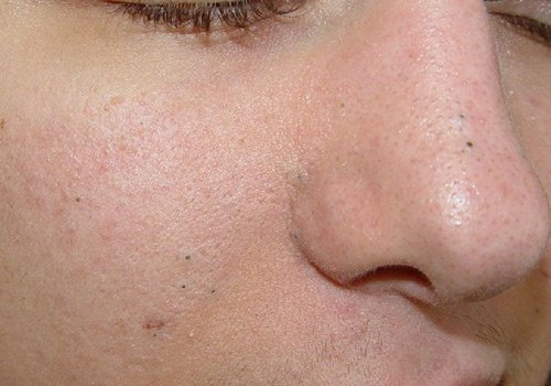 3 hemgjorda exfolieringar för att bli av med pormaskar 3 hemgjorda exfolieringar för att bli av med pormaskar