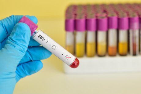 Diagnos av körtelfeber