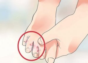 7 naturliga behandlingar för fotsvamp