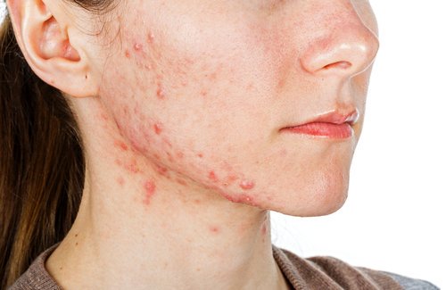 Akne är ett tecken i ansiktet som kan visa på näringsbrist
