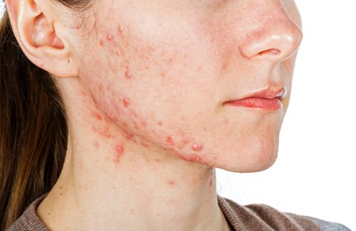 Gör en exfoliant med Himalayasalt och honung