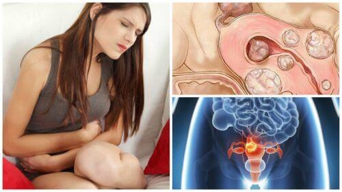 5 fakta om livmoderfibroider som varje kvinna bör känna till
