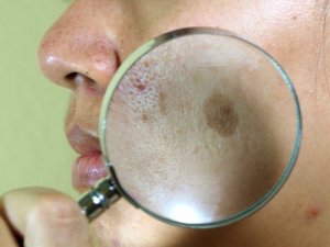 7 naturliga behandlingar för solfläckar