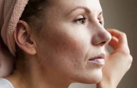 Akne och ökat ansiktshår