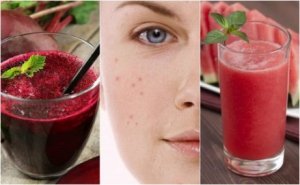 Bekämpa akne med 5 avgiftande smoothies