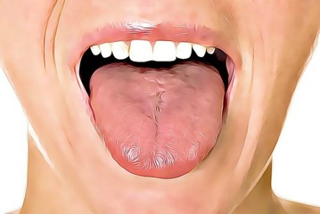 infektion på tungan