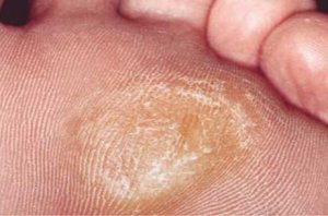 mjuka upp förhårdnader; 5 naturliga kurer