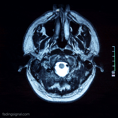 Röntgen-av-hjärnan