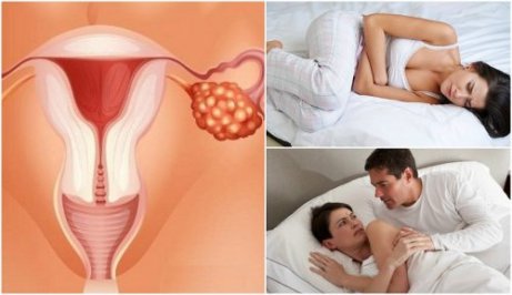 7 symptom på äggstockscancer varje kvinna bör känna till
