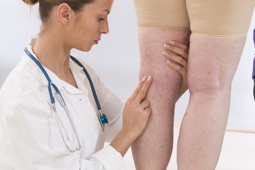 Vätskeretention kan vara ett symptom på njursvikt