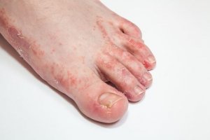 Fotsvamp (tinea pedis): orsaker, symptom & behandling