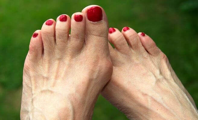 Använd bra skor för att undvika hallux valgus och förhårdnader.