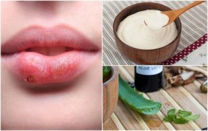 7 effektiva naturliga behandlingar för munsår