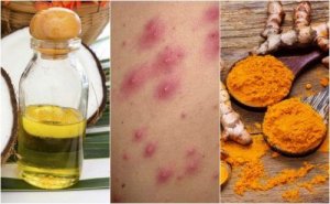 Infektion i hårsäckarna: 5 hemmakurer