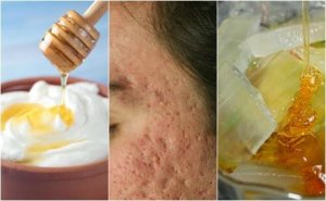 Aknemärken i ansiktet? Upptäck 5 ansiktsmasker för ärr