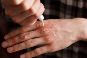 6 naturliga krämer som behandlar psoriasis