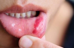 Riskfaktorer och symptom på muncancer