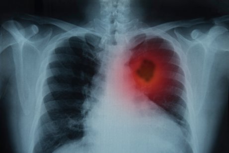 Passiv rökning kan också ge lungcancer