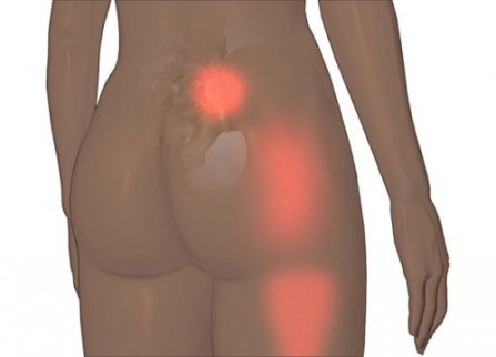 Sacroiliacaledsmärtakan kännas som diskbråck.