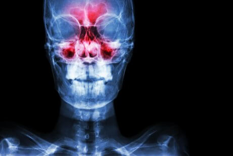 Vid en näsundersökning kan smärta visas som ett symptom på bihåleinflammation.