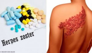 Fakta om och symptom på bältros