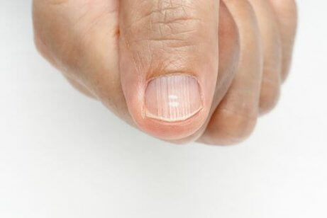 Hur man blir av med linjer på naglarna