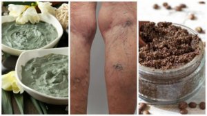 Bli av med åderbråck naturligt med dessa huskurer