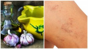 Behandla åderbråck naturligt med olivolja och vitlök