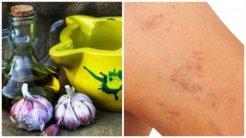 Behandla åderbråck naturligt med olivolja och vitlök