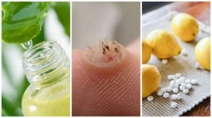 Eliminera vårtor effektivt med dessa 6 huskurer