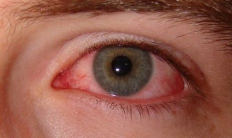 Symptomen på torra ögon-syndromet beror på vilka faktorer som ligger bakom