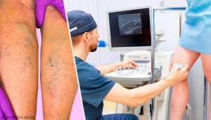 Lokala och orala behandlingar mot åderbråck