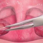 Borttagning av halsmandlarna