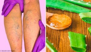 Bota åderbråck med den här aloe vera-kuren