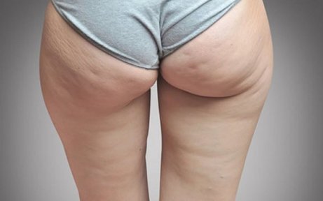 Celluliter kan orsakas av vätskeretention