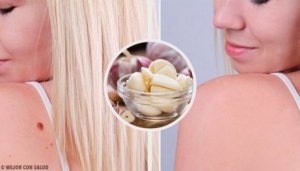 Bli av med vårtor snabbt – 9 kurer som fungerar