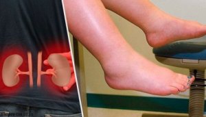 Lär dig vad som orsakar vätskeretention