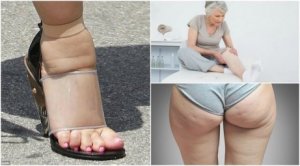 Vanliga symptom på vätskeretention